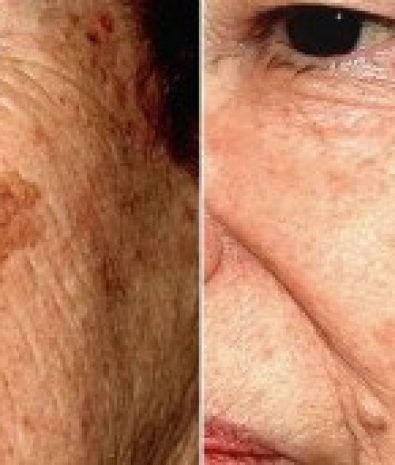 Age spots/brown spots
