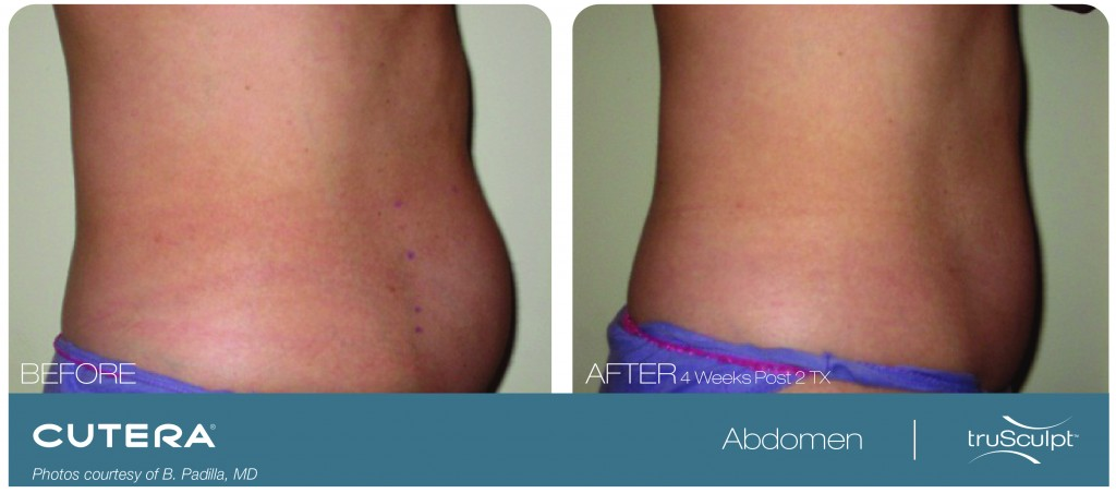 How Our Non-Invasive TruSculpt Treatment Works