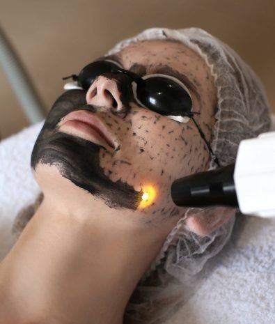 Carbon Laser Facial