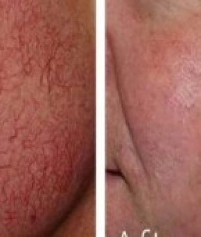 Facial Veins