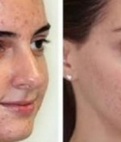 Inflammatory Acne