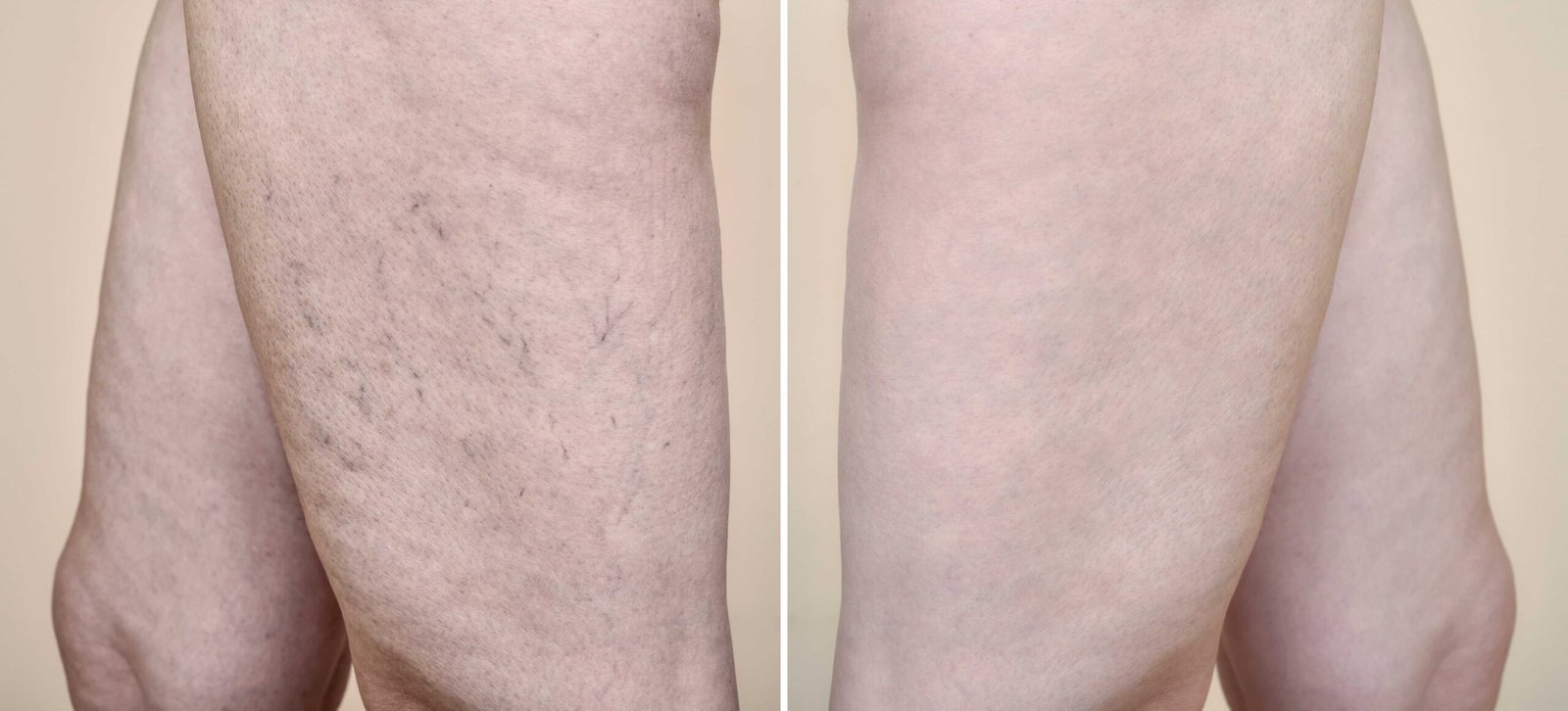 Leg Vein Treatment
