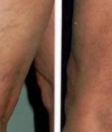 Leg Veins