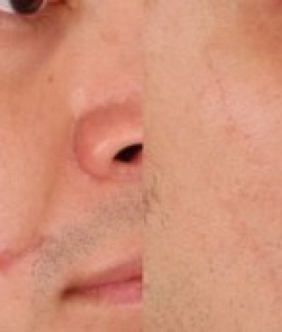 Scar Reduction