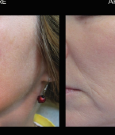 Skin Lesions