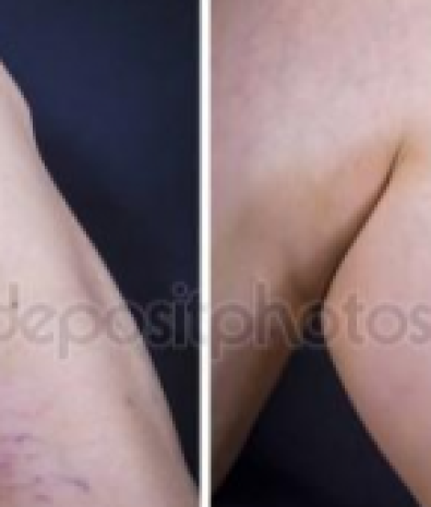 Vascular Treatment (Laser)