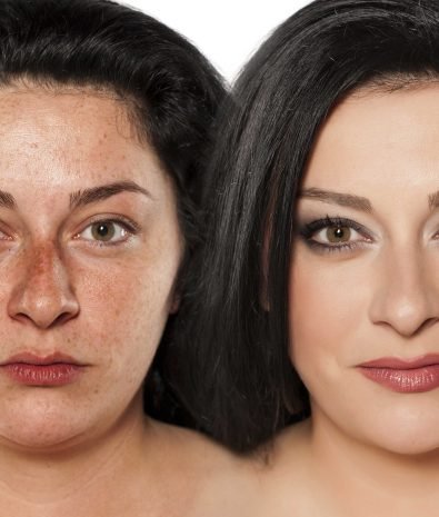 Freckle Removal