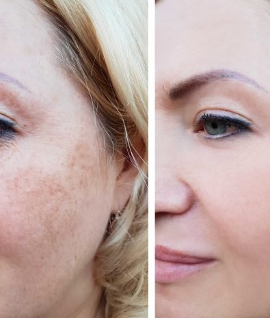 Hyperpigmentation Laser Treatment