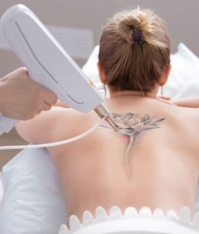 Tattoo Removal
