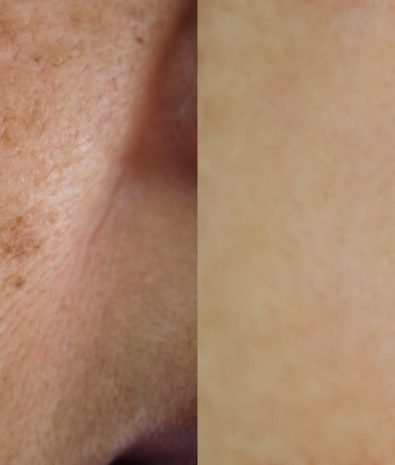 Melasma