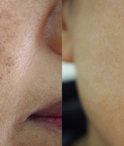 Sun damage/Sun spots