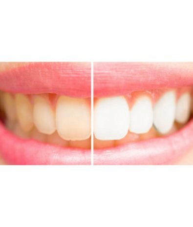 Laser Teeth Whitening